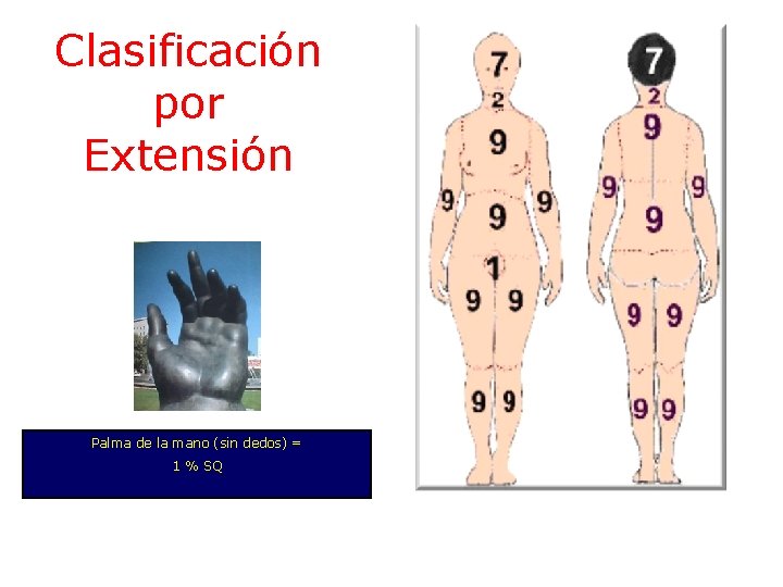 Clasificación por Extensión Palma de la mano (sin dedos) = 1 % SQ 
