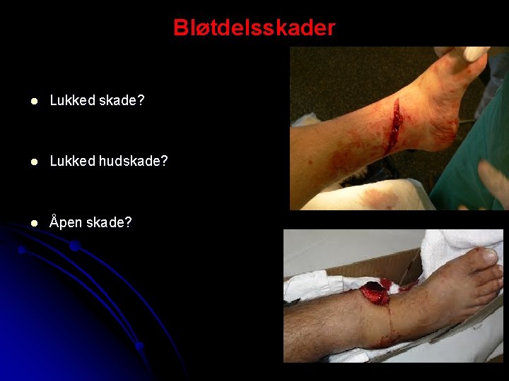 Bløtdelsskader l Lukked skade? l Lukked hudskade? l Åpen skade? 