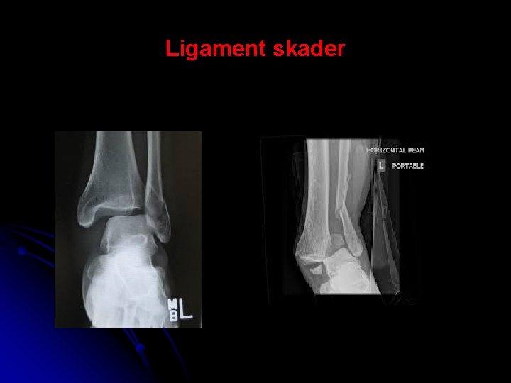 Ligament skader 