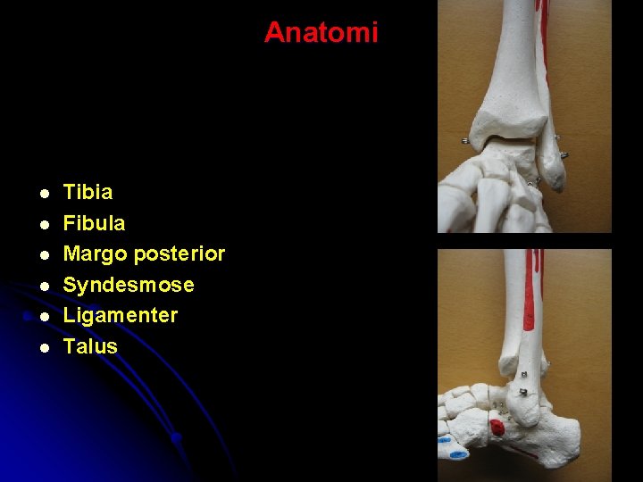 Anatomi l l l Tibia Fibula Margo posterior Syndesmose Ligamenter Talus 