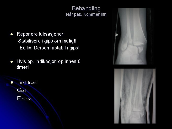 Behandling Når pas. Kommer inn l Reponere luksasjoner Stabilisere i gips om mulig!! Ex.