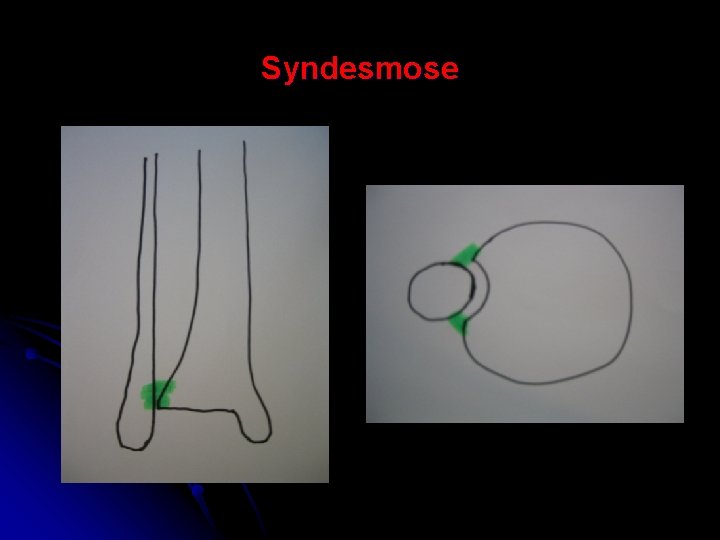 Syndesmose 