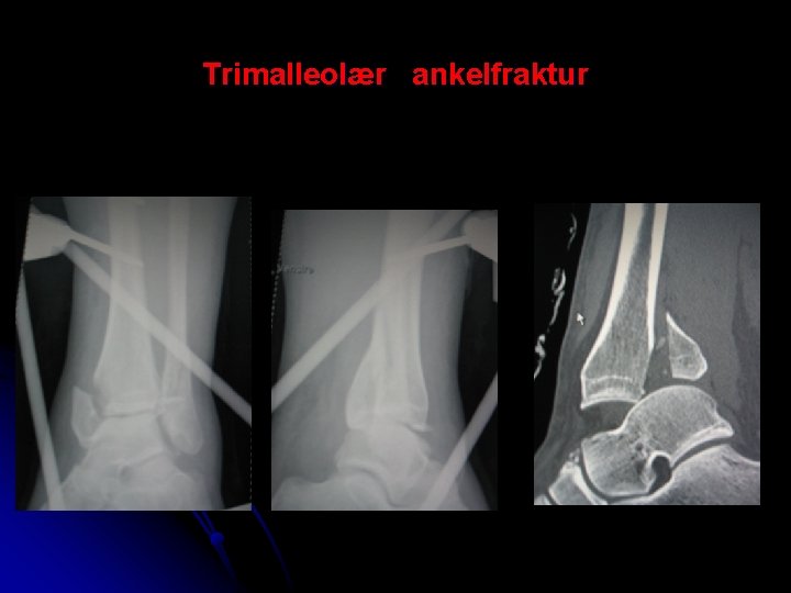 Trimalleolær ankelfraktur 