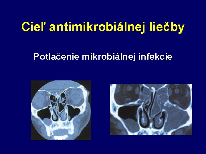 Cieľ antimikrobiálnej liečby Potlačenie mikrobiálnej infekcie 