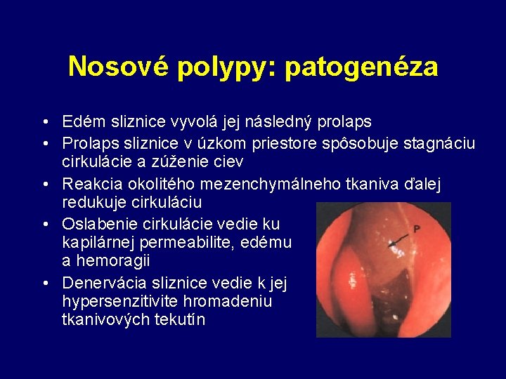 Nosové polypy: patogenéza • Edém sliznice vyvolá jej následný prolaps • Prolaps sliznice v