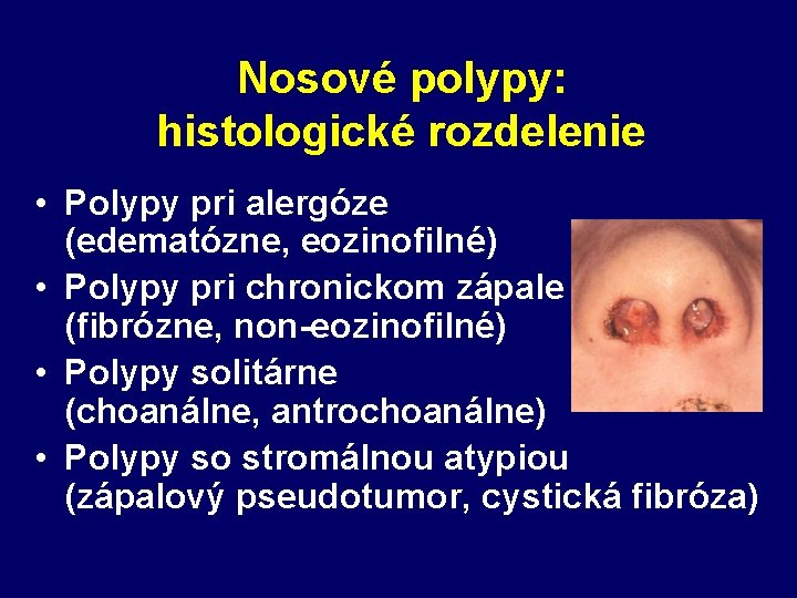 Nosové polypy: histologické rozdelenie • Polypy pri alergóze (edematózne, eozinofilné) • Polypy pri chronickom