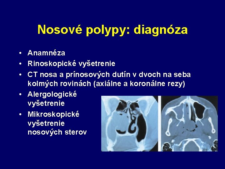 Nosové polypy: diagnóza • Anamnéza • Rinoskopické vyšetrenie • CT nosa a prínosových dutín