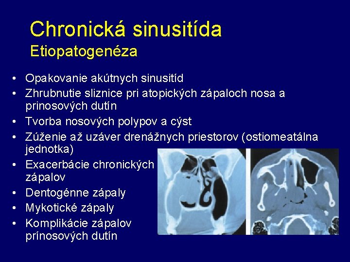 Chronická sinusitída Etiopatogenéza • Opakovanie akútnych sinusitíd • Zhrubnutie sliznice pri atopických zápaloch nosa