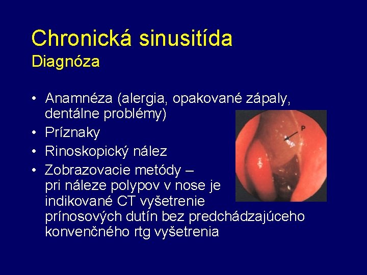 Chronická sinusitída Diagnóza • Anamnéza (alergia, opakované zápaly, dentálne problémy) • Príznaky • Rinoskopický