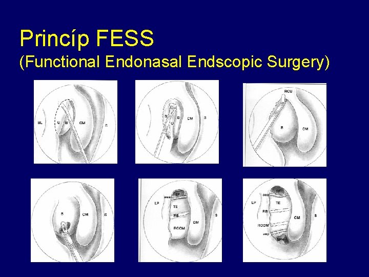 Princíp FESS (Functional Endonasal Endscopic Surgery) 