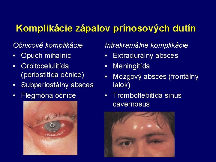 Komplikácie zápalov prínosových dutín Očnicové komplikácie • Opuch mihalníc • Orbitocelulitída (periostitída očnice) •