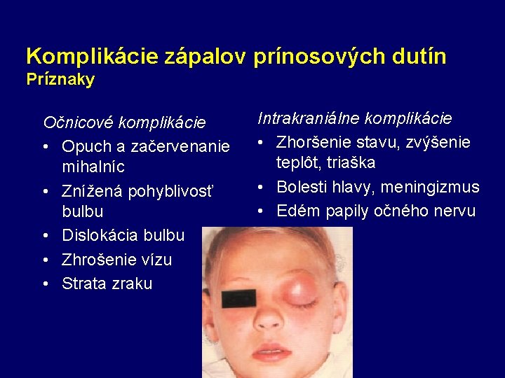 Komplikácie zápalov prínosových dutín Príznaky Očnicové komplikácie • Opuch a začervenanie mihalníc • Znížená