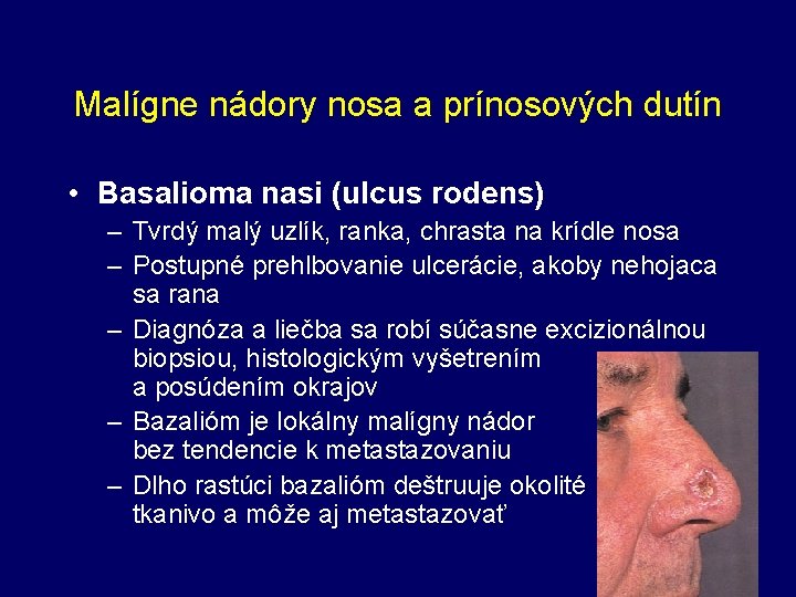 Malígne nádory nosa a prínosových dutín • Basalioma nasi (ulcus rodens) – Tvrdý malý
