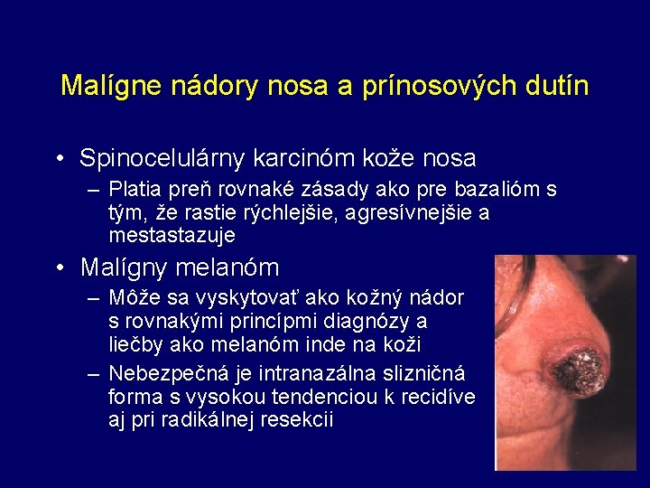 Malígne nádory nosa a prínosových dutín • Spinocelulárny karcinóm kože nosa – Platia preň