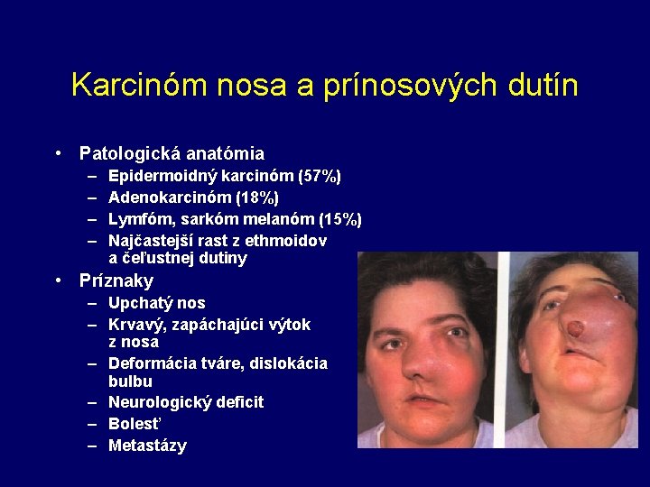 Karcinóm nosa a prínosových dutín • Patologická anatómia – – Epidermoidný karcinóm (57%) Adenokarcinóm