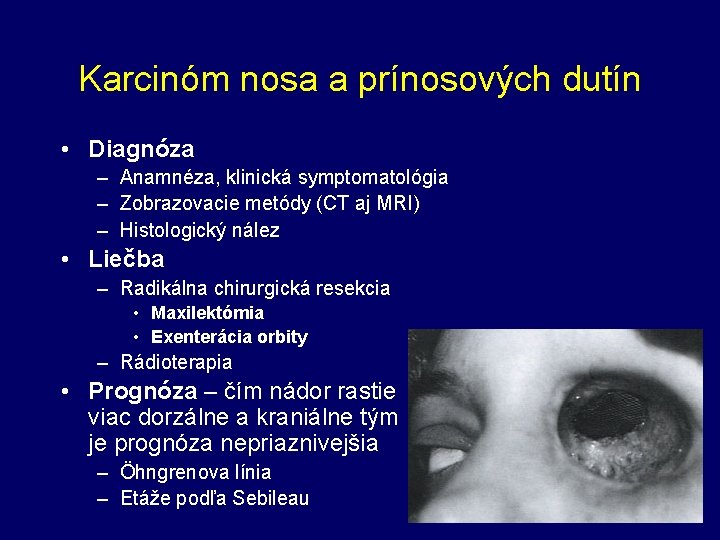 Karcinóm nosa a prínosových dutín • Diagnóza – Anamnéza, klinická symptomatológia – Zobrazovacie metódy