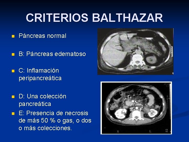 CRITERIOS BALTHAZAR n Páncreas normal n B: Páncreas edematoso n C: Inflamación peripancreática n