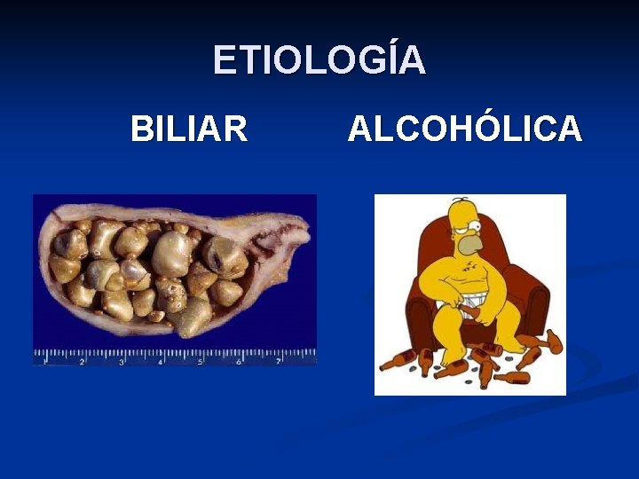 ETIOLOGÍA BILIAR ALCOHÓLICA 