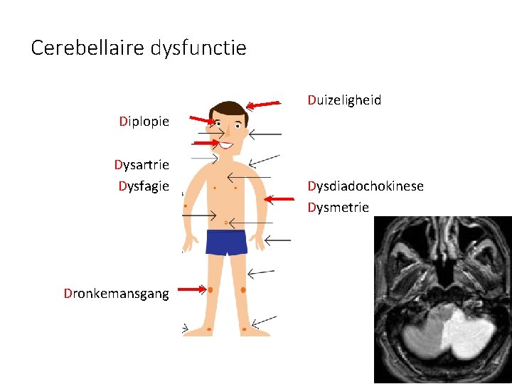 Cerebellaire dysfunctie Duizeligheid Diplopie Dysartrie Dysfagie Dronkemansgang Dysdiadochokinese Dysmetrie 