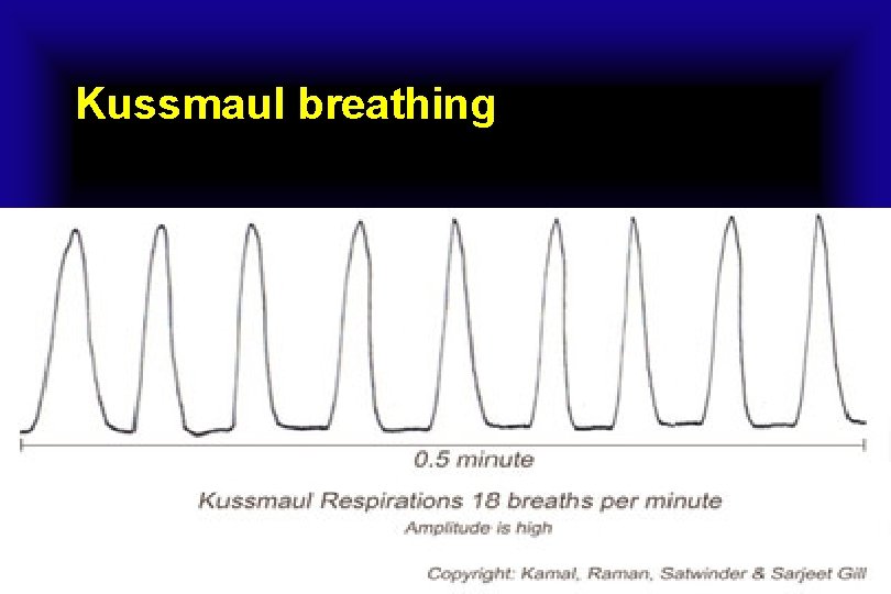 Kussmaul breathing 