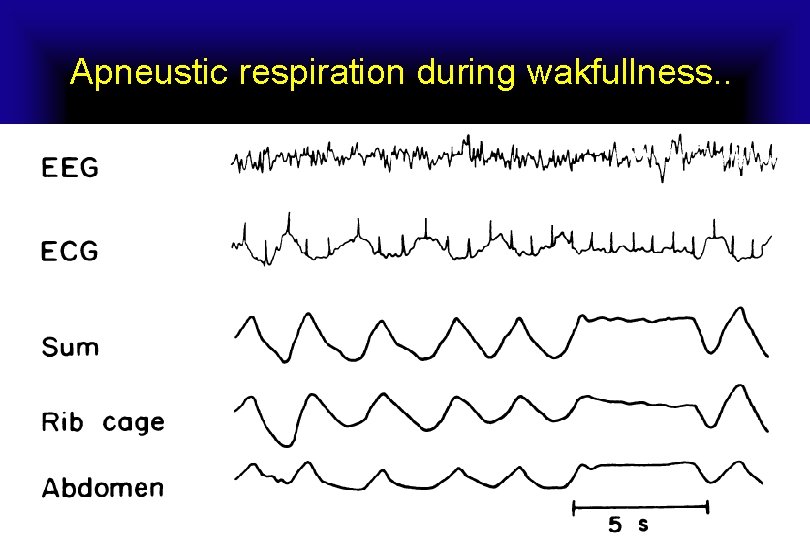 Apneustic respiration during wakfullness. . 
