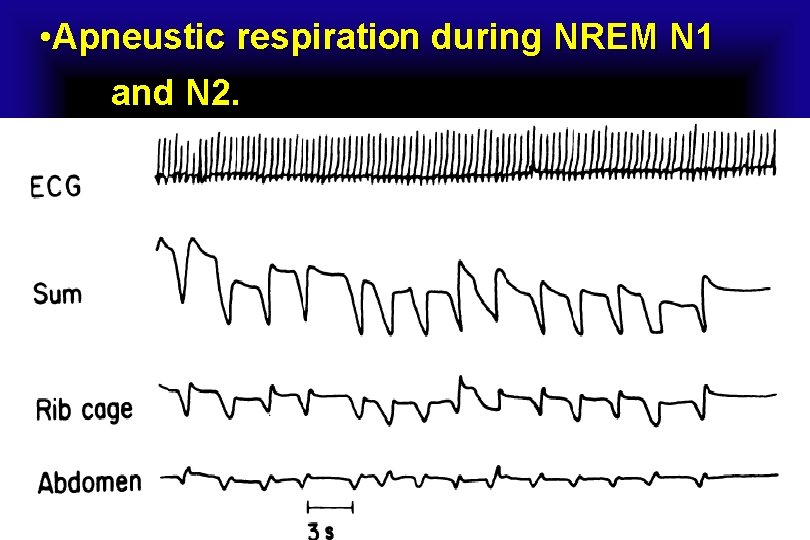  • Apneustic respiration during NREM N 1 and N 2. 
