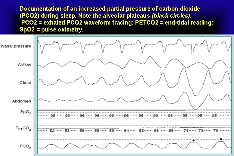 Documentation of an increased partial pressure of carbon dioxide (PCO 2) during sleep. Note