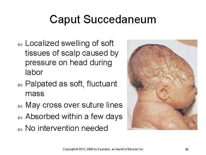 Caput Succedaneum Localized swelling of soft tissues of scalp caused by pressure on head