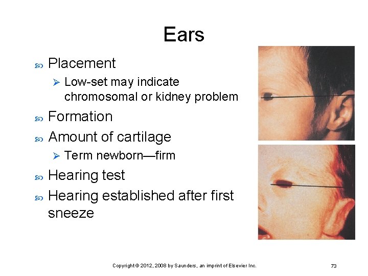 Ears Placement Ø Formation Amount of cartilage Ø Low-set may indicate chromosomal or kidney