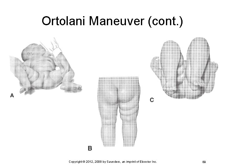 Ortolani Maneuver (cont. ) Copyright © 2012, 2008 by Saunders, an imprint of Elsevier