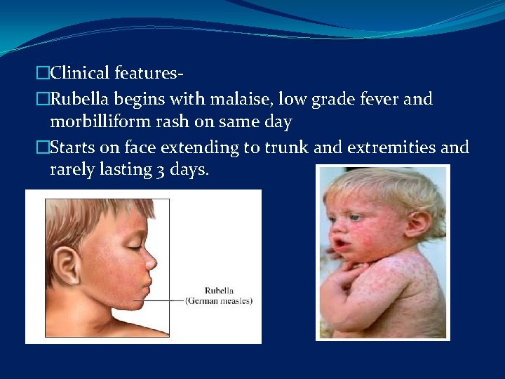 �Clinical features- �Rubella begins with malaise, low grade fever and morbilliform rash on same