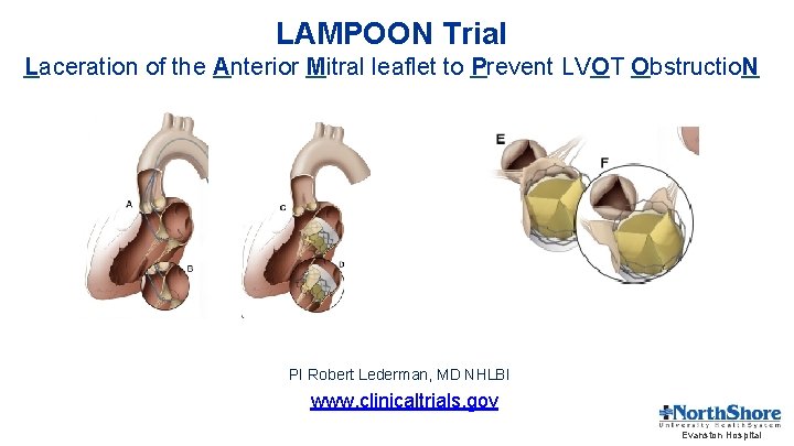 LAMPOON Trial Laceration of the Anterior Mitral leaflet to Prevent LVOT Obstructio. N PI