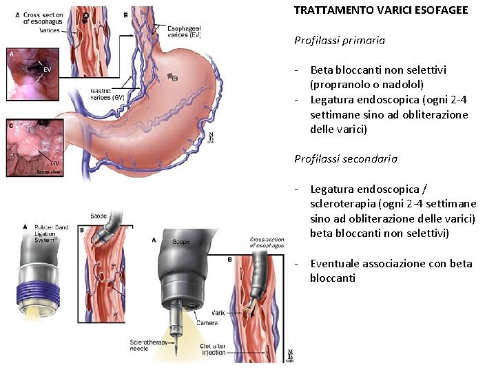 TRATTAMENTO VARICI ESOFAGEE Profilassi primaria - Beta bloccanti non selettivi (propranolo o nadolol) -