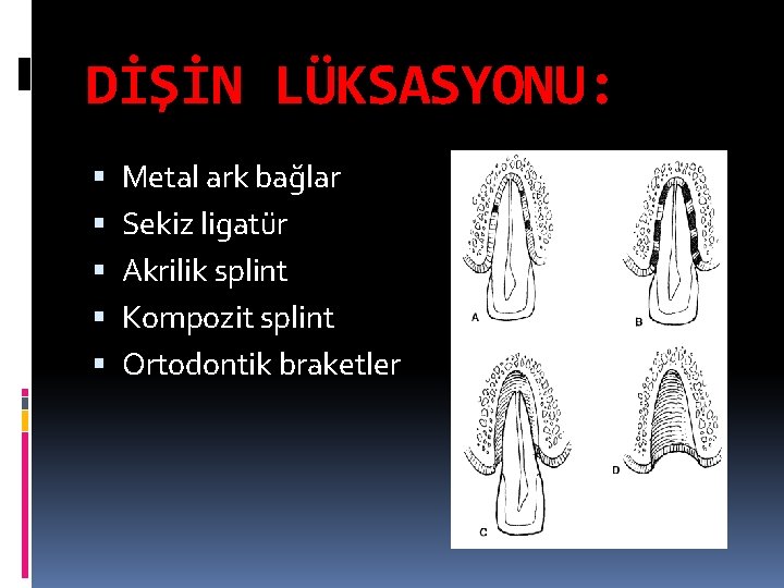 DİŞİN LÜKSASYONU: Metal ark bağlar Sekiz ligatür Akrilik splint Kompozit splint Ortodontik braketler 