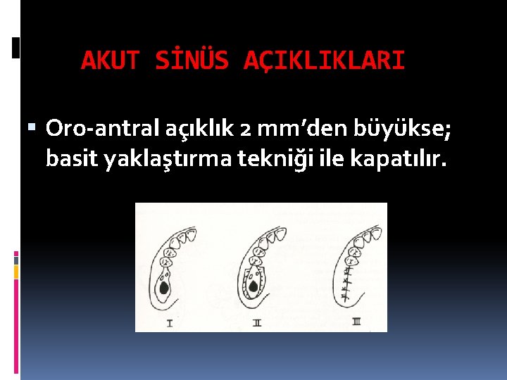 AKUT SİNÜS AÇIKLIKLARI Oro-antral açıklık 2 mm’den büyükse; basit yaklaştırma tekniği ile kapatılır. 