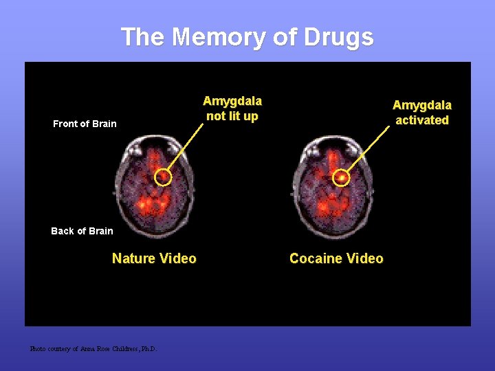 The Memory of Drugs Front of Brain Amygdala not lit up Amygdala activated Back