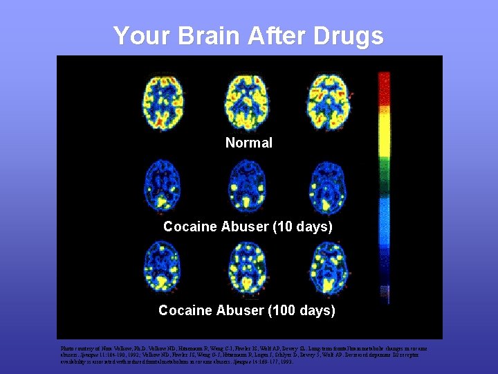 Your Brain After Drugs Normal Cocaine Abuser (10 days) Cocaine Abuser (100 days) Photo
