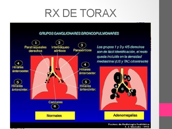 RX DE TORAX 