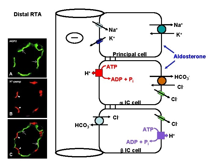 Distal RTA Na+ K+ K+ Principal cell Aldosterone ATP H+ HCO 3 - ADP