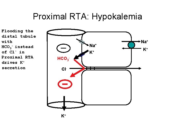 Proximal RTA: Hypokalemia Flooding the distal tubule with HCO 3 - instead of Cl-