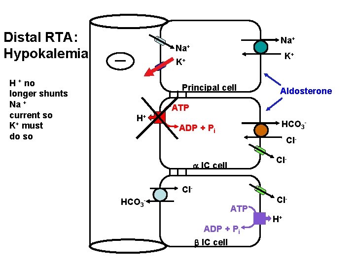 Distal RTA: Hypokalemia H + no longer shunts Na + current so K+ must