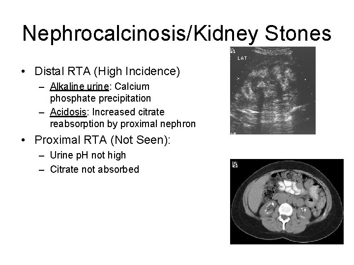 Nephrocalcinosis/Kidney Stones • Distal RTA (High Incidence) – Alkaline urine: Calcium phosphate precipitation –