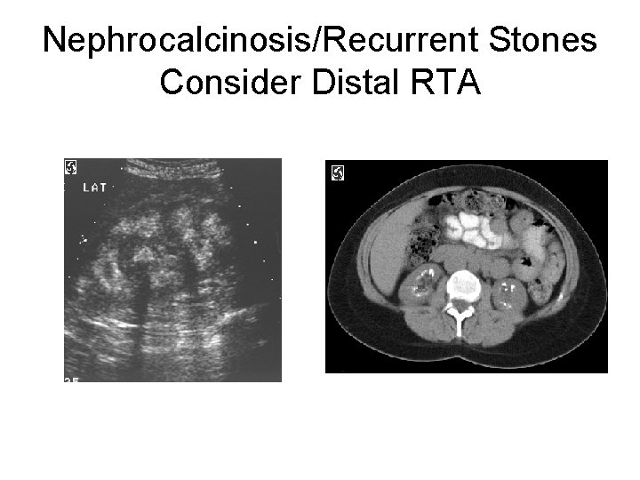 Nephrocalcinosis/Recurrent Stones Consider Distal RTA 