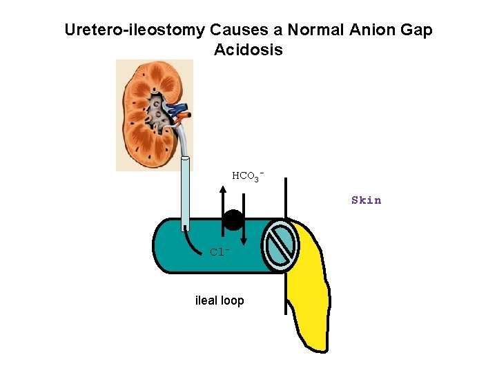Uretero-ileostomy Causes a Normal Anion Gap Acidosis HCO 3 Skin Cl- ileal loop 