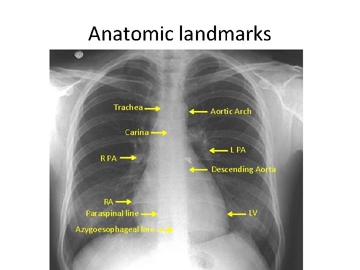 Anatomic landmarks Trachea Aortic Arch Carina R PA L PA Descending Aorta RA Paraspinal