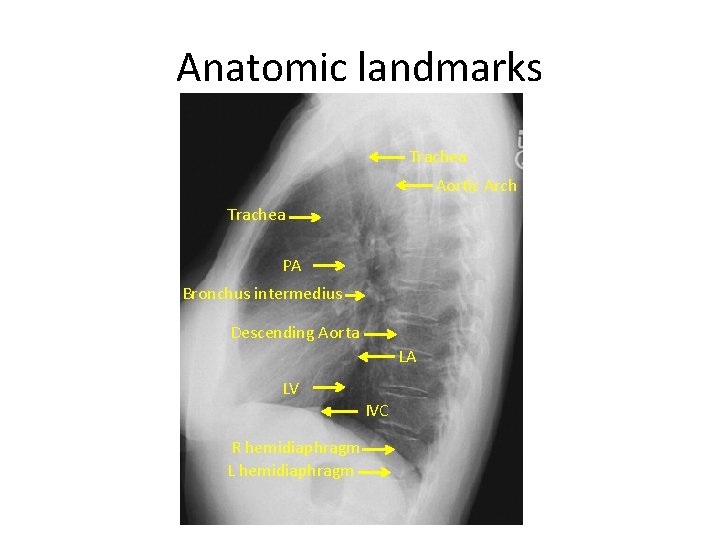 Anatomic landmarks Trachea Aortic Arch Trachea PA Bronchus intermedius Descending Aorta LA LV R