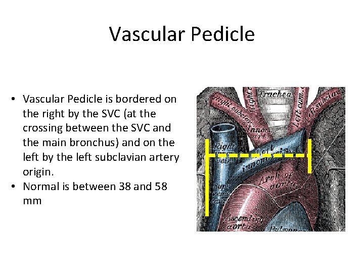 Vascular Pedicle • Vascular Pedicle is bordered on the right by the SVC (at
