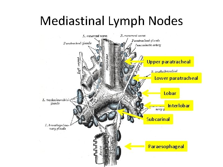 Mediastinal Lymph Nodes Upper paratracheal Lower paratracheal Lobar Interlobar Subcarinal Paraesophageal 