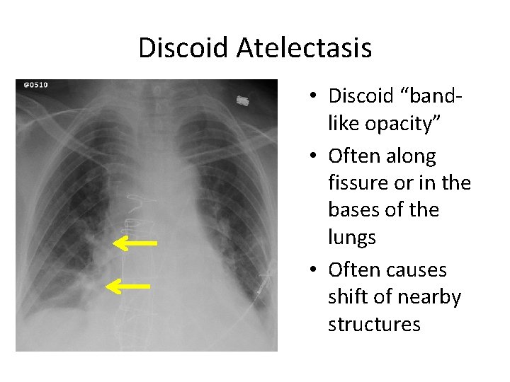 Discoid Atelectasis • Discoid “bandlike opacity” • Often along fissure or in the bases