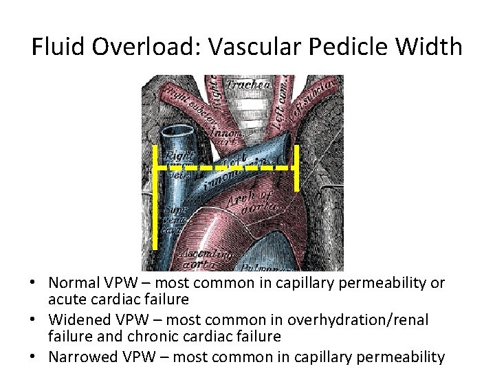Fluid Overload: Vascular Pedicle Width • Normal VPW – most common in capillary permeability